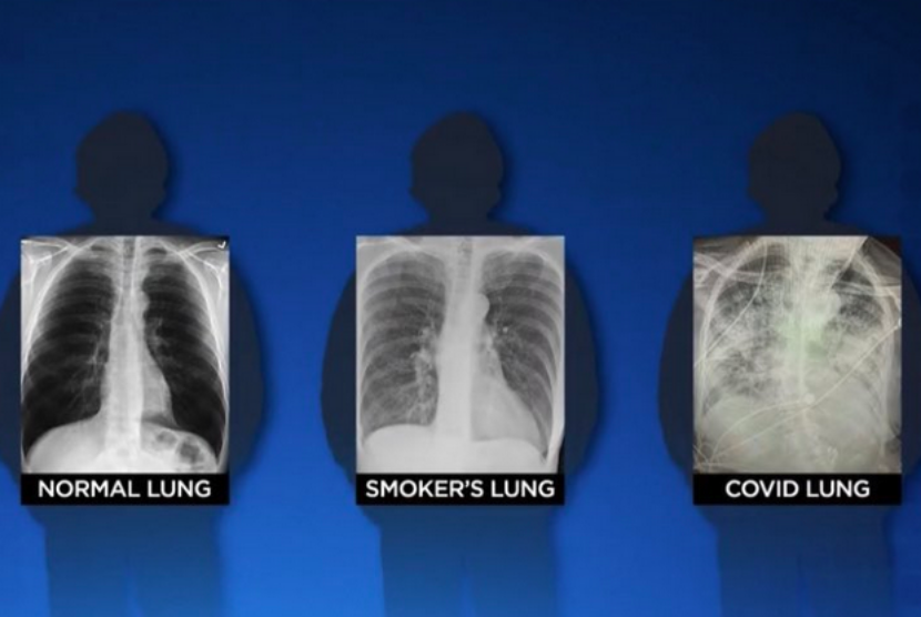 Pakar: Paru-paru Penyintas Covid Lebih Buruk dari Perokok